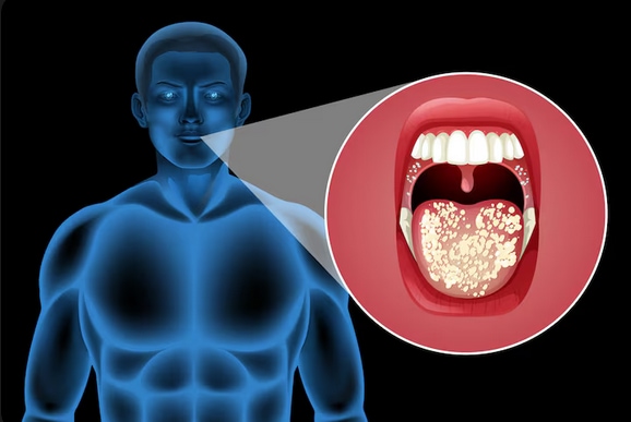 Oral cancer causes