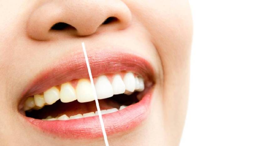 Best Home Remedies For Teeth Whitening
