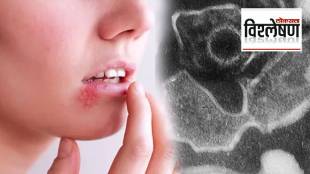 Kissing Disease symptoms and Epstein-Barr Virus risks