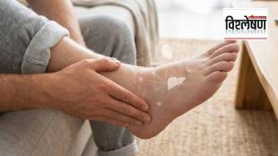 Swollen feet indicating potential heart or kidney failure symptoms