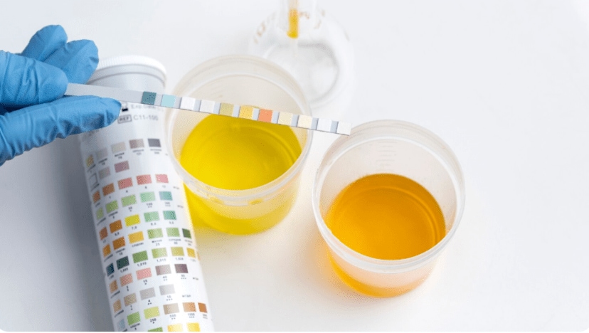Different Shades Of Urine Does White Urine Means You Are Suffering From Diabetes What The Color Of Your Pee mean