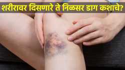 World Hemophilia Day 2026 : दुखापत झाली नसतानाही शरीरावर दिसतायत निळसर डाग; असू शकते ‘या’ गंभीर आजाराचे लक्षण