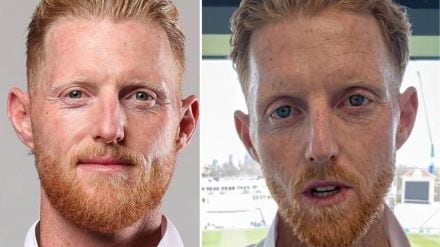 Ben Stoke Surgery