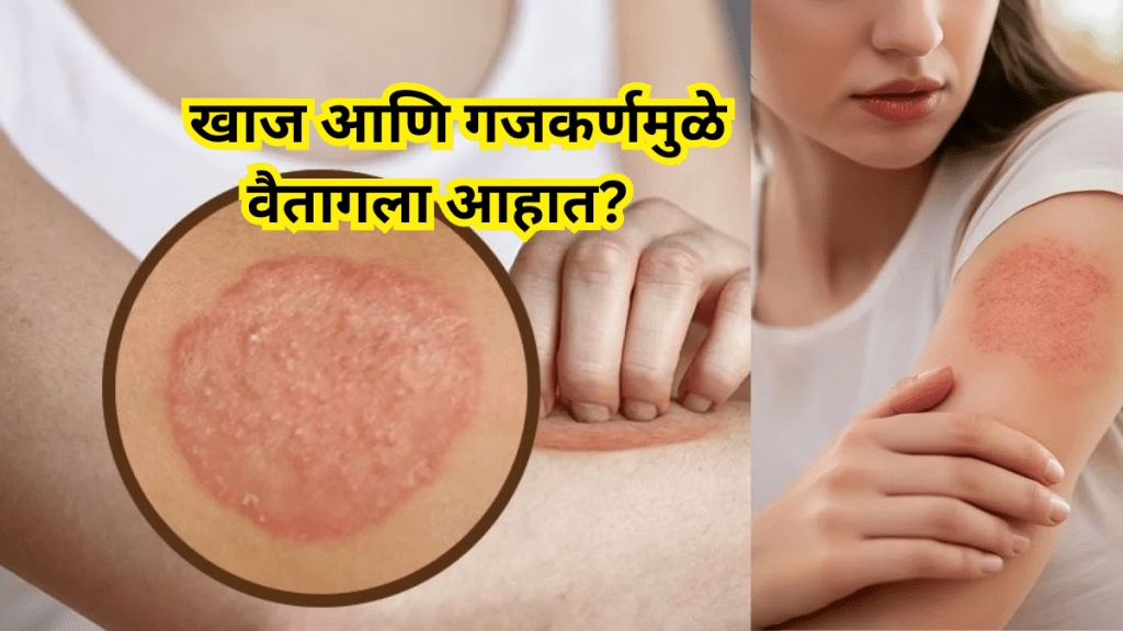 Ayurvedic treatment for Ringworm, Home remedies for fungal infection, Ayurvedic treatment for Ringworm, Home remedies for fungal infection,