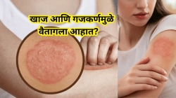 Skin Care Tips: बदलत्या ऋतूत वाढतेय गजकर्ण-खाजेचा त्रास, आयुर्वेदिक तज्ज्ञ सांगतात सुरक्षित उपाय
