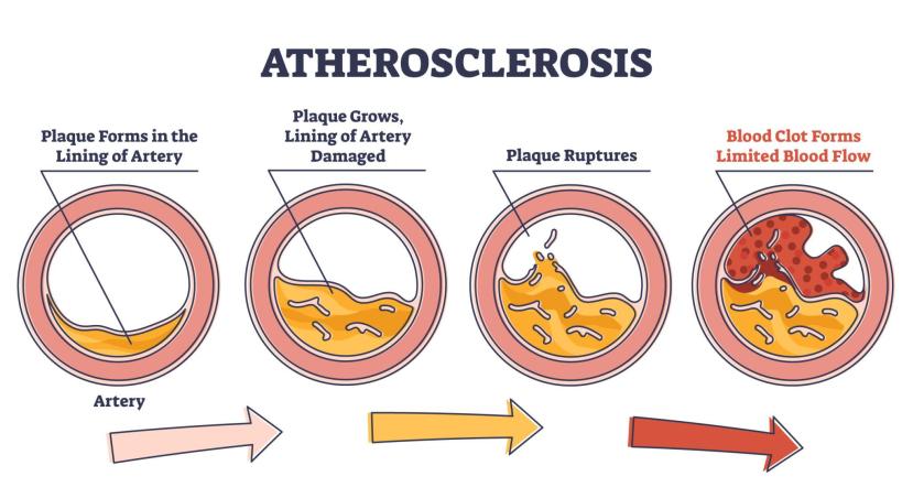 ATHEROSCLEROSIS PATHOPHYSIOLOGY