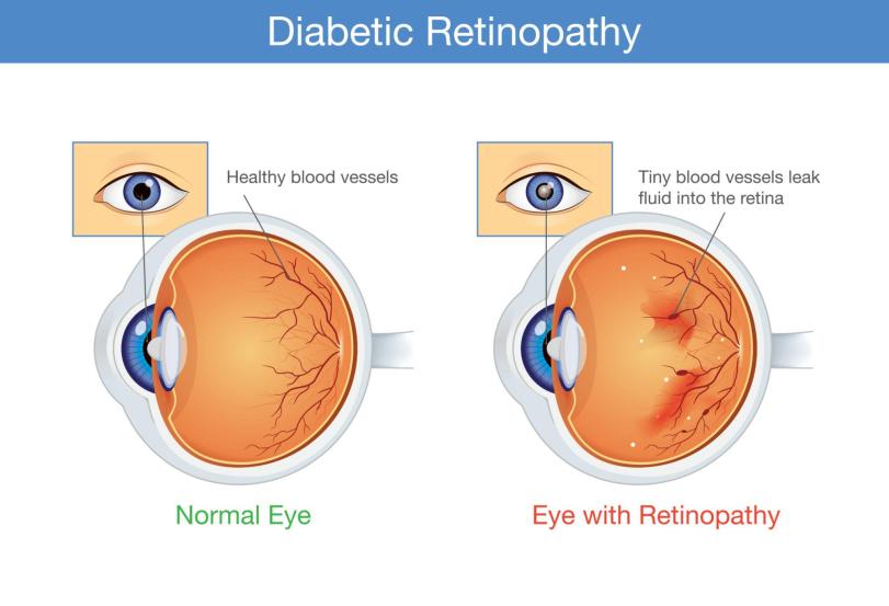 DIABETIC RETINOPATHY