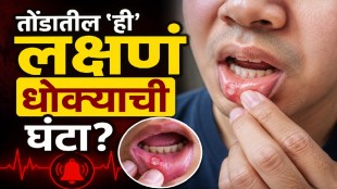 Early warning signs of oral cancer including mouth ulcers and persistent voice changes