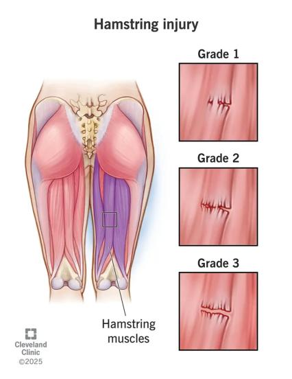 Hamstring Injury Grades