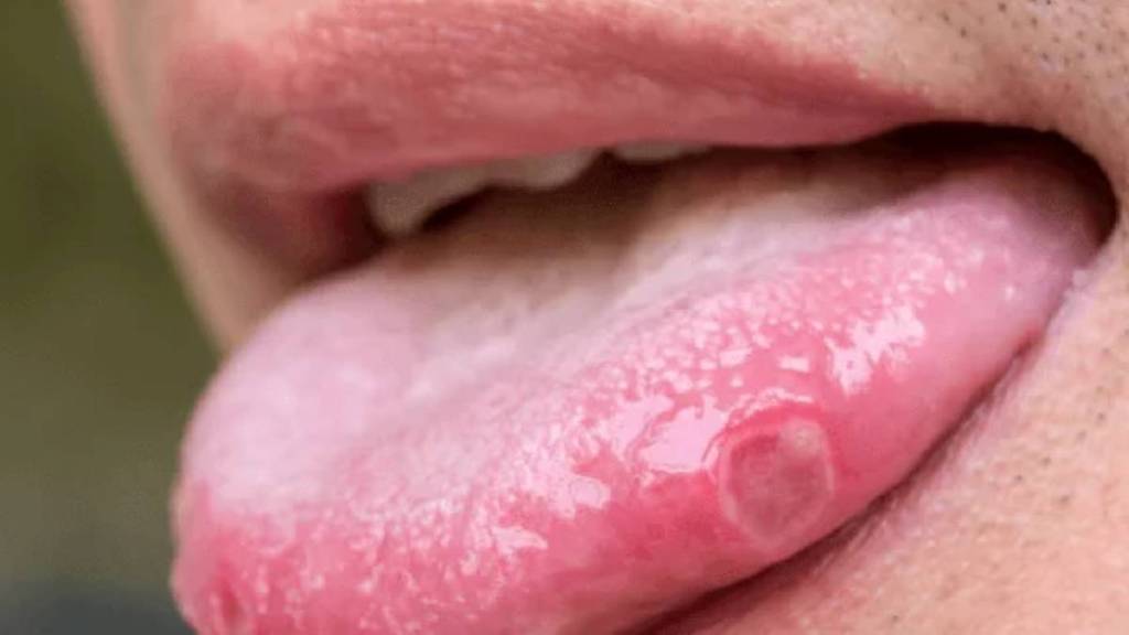 Mouth Ulcer Causes & Remedies Mouth Ulcer Causes & Remedies