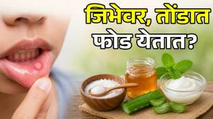 Simple Home Remedies for Tongue mouth Ulcers