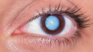 human eye structure diagram | cataract transparent lens turbidity | natural crystalline protein reflection | eye surgery artificial lens implantation