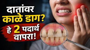 Garlic and cloves as common kitchen ingredients for temporary toothache relief and oral health