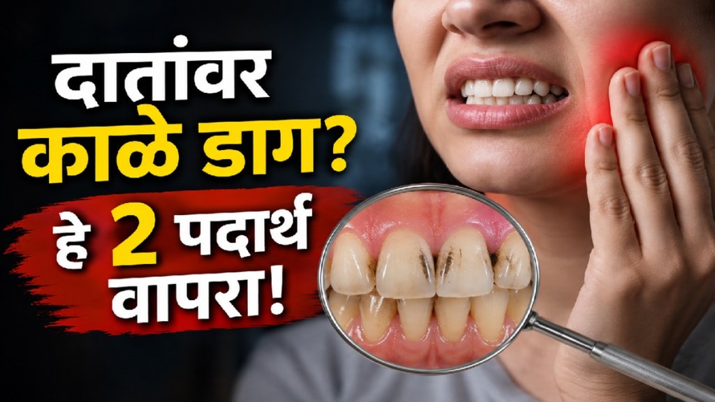 Garlic and cloves as common kitchen ingredients for temporary toothache relief and oral health Garlic and cloves as common kitchen ingredients for temporary toothache relief and oral health