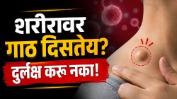 शरीरावरील प्रत्येक गाठीला साधी समजू नका! ‘हा’ सायलेंट कॅन्सरही असू शकतो; तज्ज्ञांनी सांगितली सुरुवातीची ६ धोक्याची लक्षणे