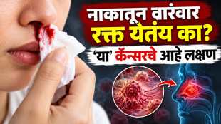 Nosebleed symptoms and health warning | Nasal cavity sinus cancer early signs | Medical warning signs for frequent nosebleeding | Health tips for nasal cancer diagnosis and prevention
