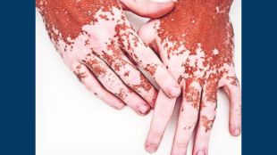 vitiligo skin disorder causes marathi | melanin deficiency skin white patches | kutuhal marathi vigyan parishat article | autoimmune skin disease treatment updates