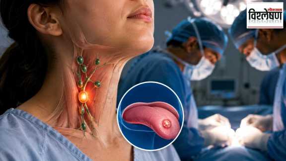 Tongue cancer treatment Sentinel Lymph Node Biopsy neck surgery avoidance Mumbai