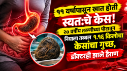 ११ वर्षांपासून खात होती स्वतःचे केस! २० वर्षीय तरुणीच्या पोटातून निघाला तब्बल १.१६ किलोचा केसांचा गुच्छ, डॉक्टरही झाले हैराण