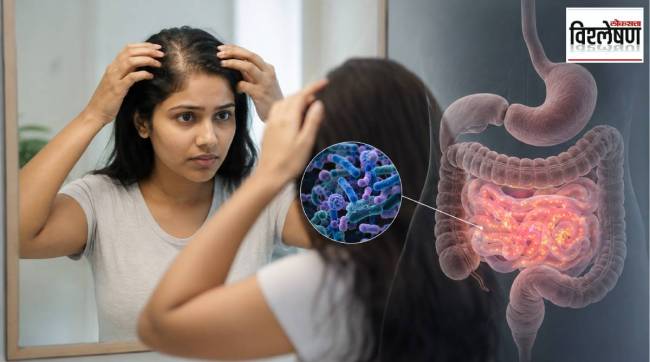 Hair Loss Bloating Low Ferritin SIBO Symptoms Gut Health Bacteria Treatment