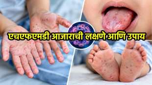 HFMD Virus Symptoms Treatment