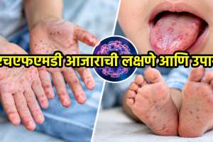 HFMD Virus Symptoms Treatment