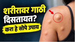 अंगावरील चरबीच्या गाठी चुटकीत वितळून जातील! करा ‘हे’ ३ सोपे घरगुती उपाय; पुन्हा येणार नाहीत शरीरावर गाठी