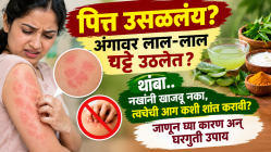 पित्त उसळलंय? अंगावर लाल-लाल चट्टे उठलेत? थांबा.. नखांनी खाजवू नका, त्वचेची आग कशी शांत करावी? जाणून घ्या कारण अन् घरगुती उपाय