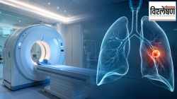 Lung Cancer Screeening : फुप्फुसाचा कॅन्सर वेळेत कसा ओळखायचा? सुरुवातीच्या टप्प्यांत स्क्रीनिंग केल्यास मृत्यूचा धोका टळू शकतो का?